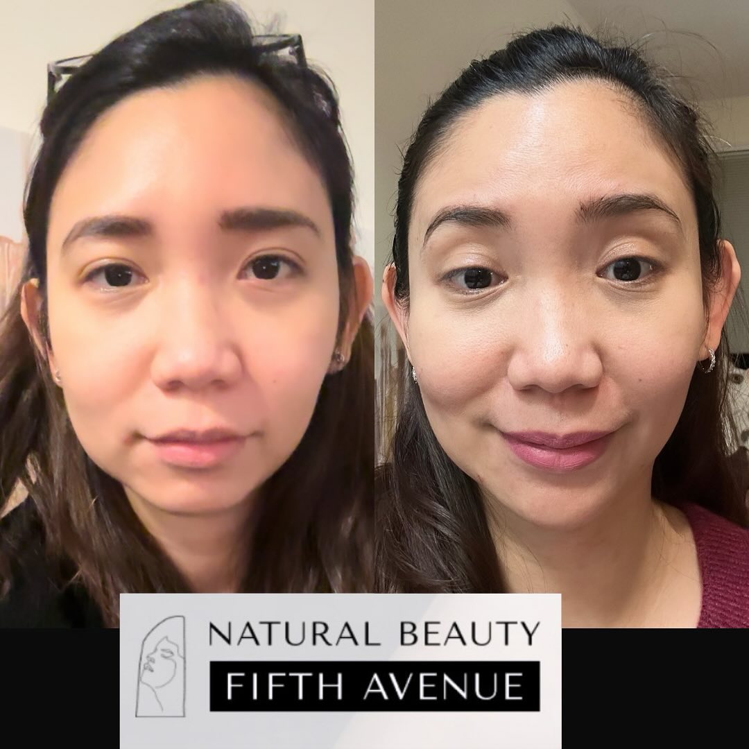 Before and after laser resurfacing results showing improved skin texture and radiance